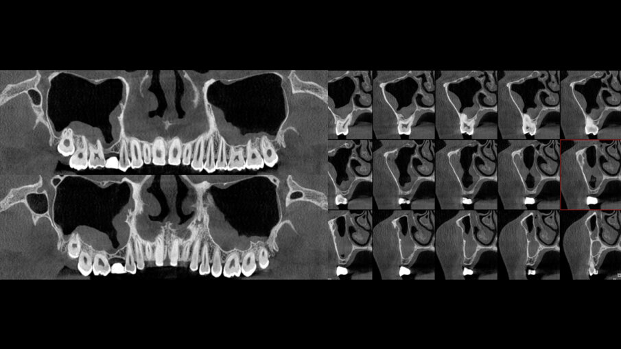 Obr. 1: Počáteční sken z CT s koronárními a sagitálními řezy.