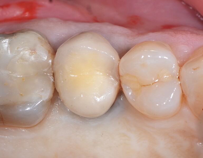 Fig. 14 : Dent irrécupérable. 