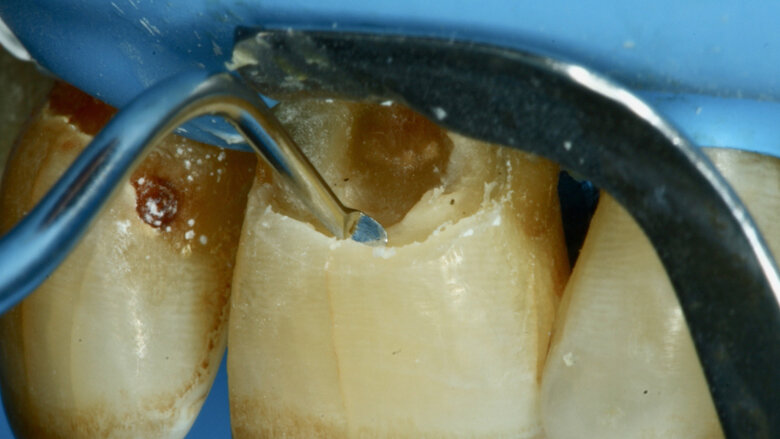 Figuras 8 y 9. Se complementa la instrumentación mecánica en el límite amelo-dentinario.