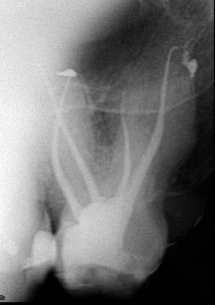 Fig. 7c: Immediate post-op radiographs showing 3D filling of the root canal system at different angulations.