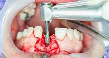 Dental implants market in China to grow at a CAGR of 28.26 per cent