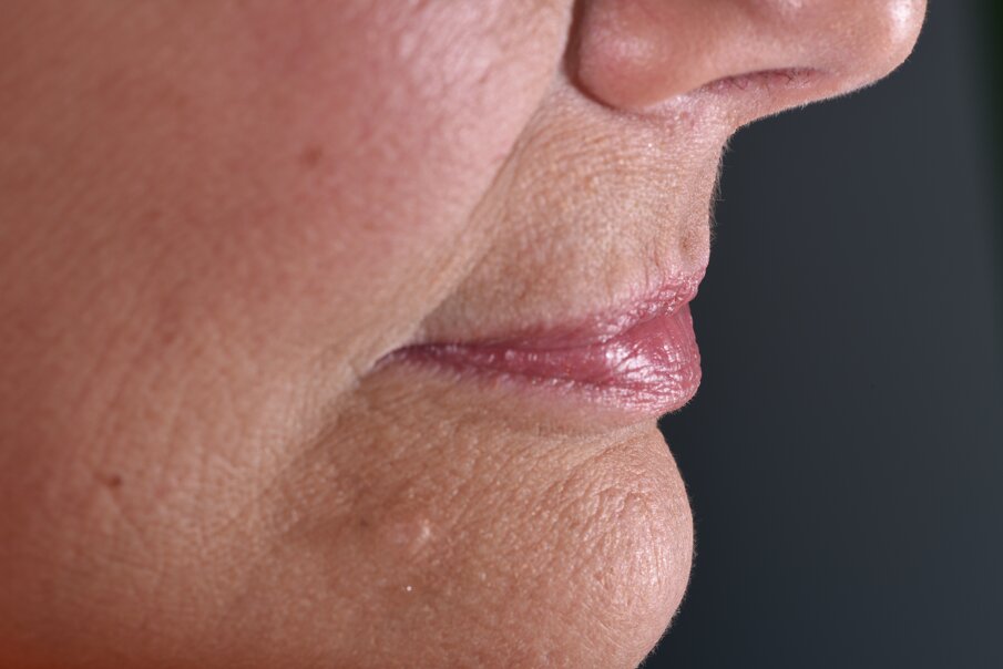 Fig. 4_Profilo della paziente senza provvisorio, si noti il collasso del labbro con il caratteristico “codice a barra” che rende sgradevole l’impatto estetico.