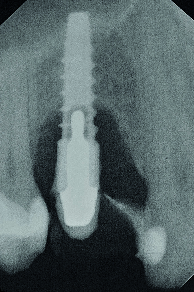 Fig. 2 : Radiographie de
l‘implant