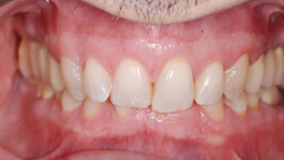 Proper curve of Spee levelling as a key factor in the treatment of deep bite with aligners