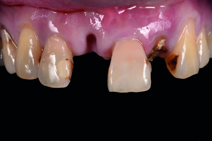 Fig. 1: Pre-op frontal view of the anterior teeth.