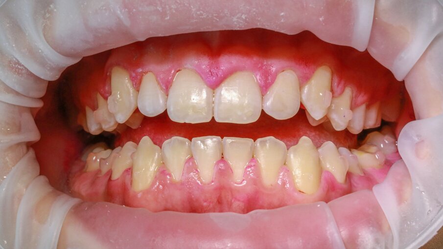 Fig. 8 - Dopo la pulizia con la polvere PLUS, il paziente riacquista una bocca pulita (© Marie-Claude Ekstand).