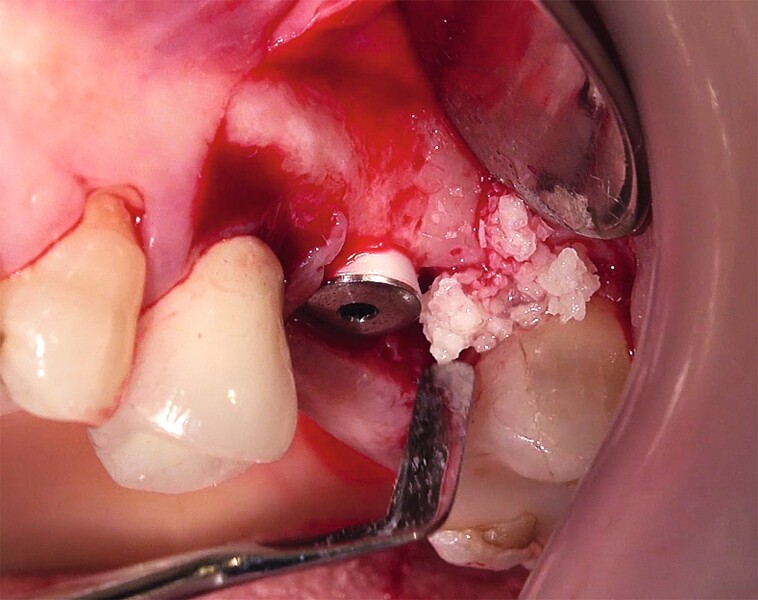 Fig. 41 : Greffe osseuse et régénération tissulaire guidée au niveau de la face mésiale de la deuxième molaire.