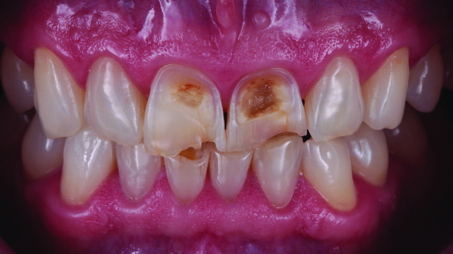 INITIAL SITUATION: Preoperative frontal view of the patient’s teeth, showing severe erosive tooth wear on the vestibular surfaces and incisal edges.