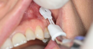 Usunięcie złamanego narzędzia endodontycznego wbitego w kości szczęki – opis przypadku
