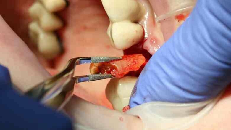Atraumatic extraction of maxillary second premolar
