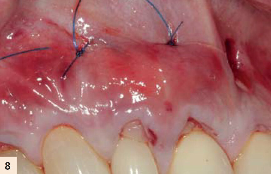 figure 8 : La suture périostée apicale en-dessous de la jonction muco-gingivale va « élever » le complexe A-PRF/lambeau en direction coronaire. La proximité intime entre les membranes d’A-PRF et les ligaments parodontaux permettra une libération lente des facteurs de croissance, favorisant ainsi la kératinisation.