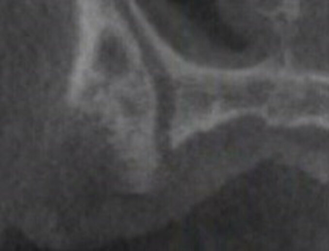 Fig. 4 - Immagine parassiale di CBCT raffigurante il forame accessorio del CS.
