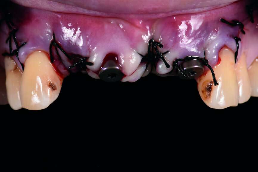 Fig. 5: Frontal view of the anterior teeth immediately post-op.