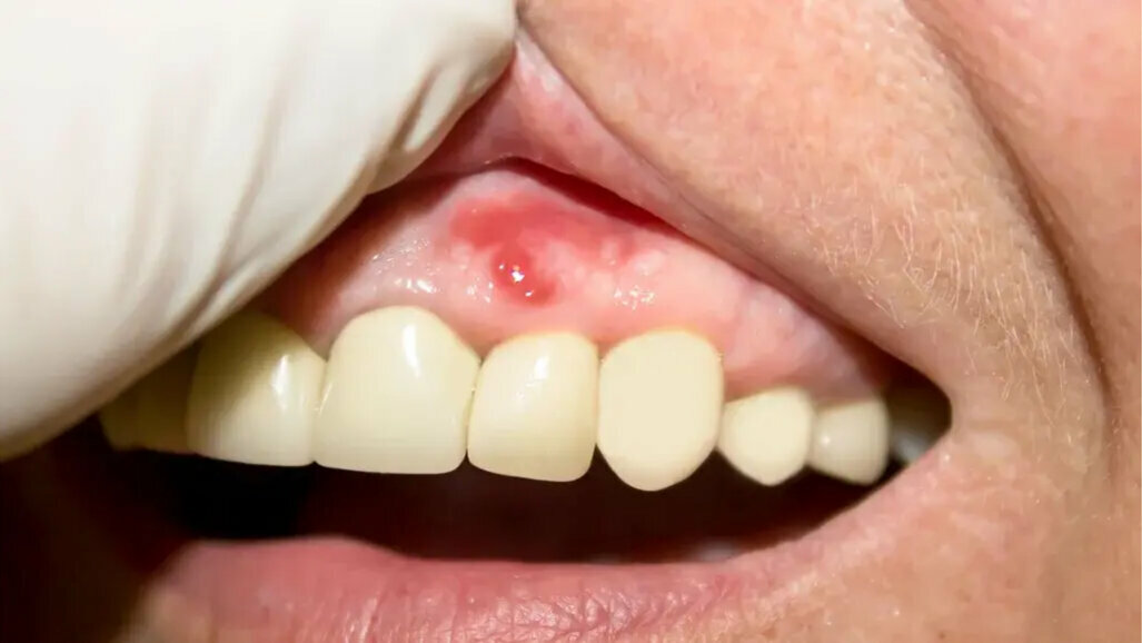 Gingival stiffness affects susceptibility to inflammation, according to new study