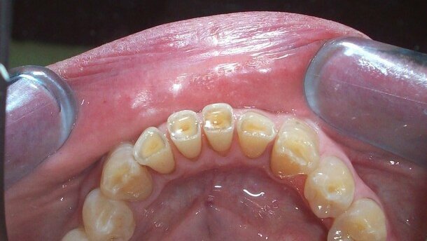 Relazione tra erosione dentale e reflusso gastro-esofageo