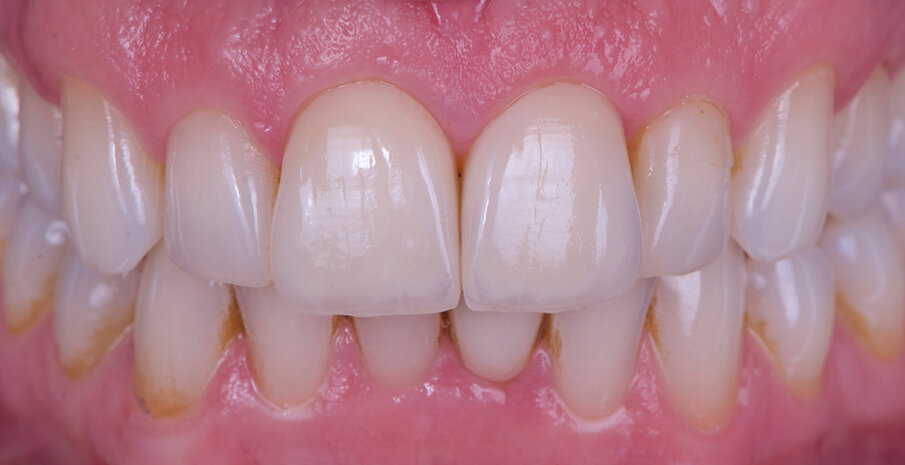 Fig. 11 & 12: Veneers on the UR 1 and UL 1: The brightness value of the adjacent teeth has been reproduced exactly. There is a natural in-depth effect within a minimal layering thickness.