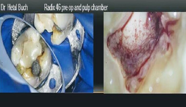 Radix 46 Preop and Pul chamber appearance