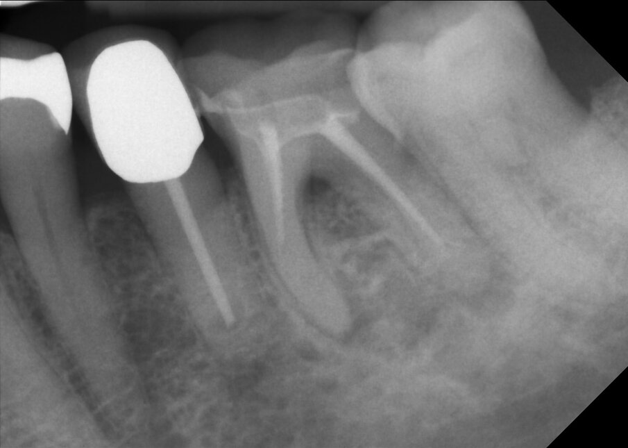 Fig. 1: Pre-op radiographic image of tooth #36.