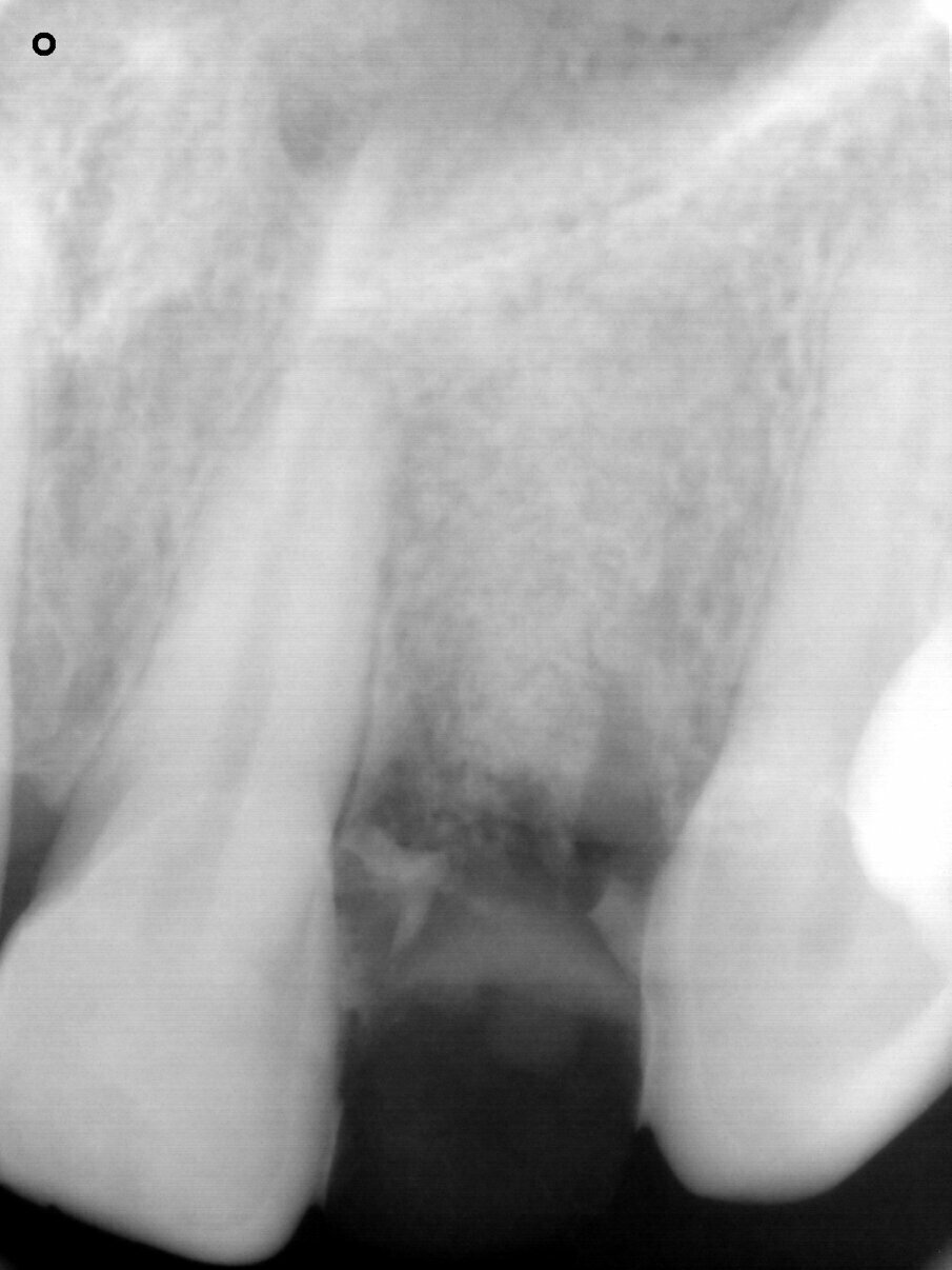 Fig. 5: Periapical radiograph after socket preservation. Note the bone material acting as a scaffold to support the peri-implant soft tissue.