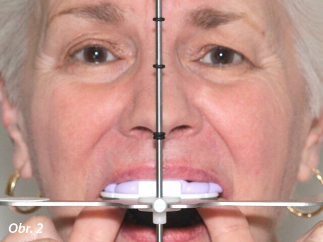Obr. 2: Pacientka drží systém Kois Dento-Facial Analyzer; středová tyčka odpovídá středové linii obličeje a Foxova deska je rovnoběžná s bipupilární linií