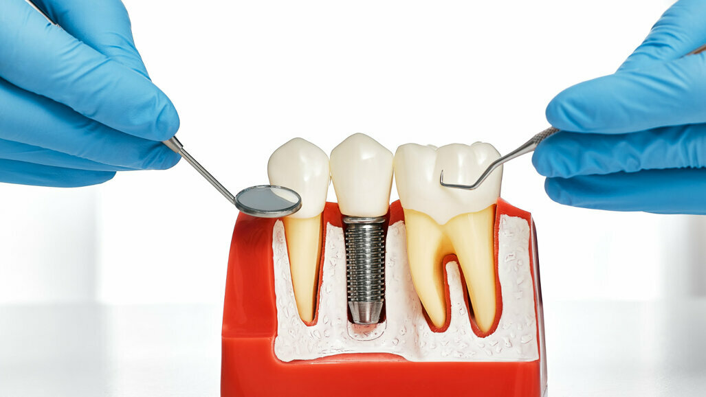 Lebenslang gesunde Zahnimplantate - Wunsch oder Wirklichkeit?