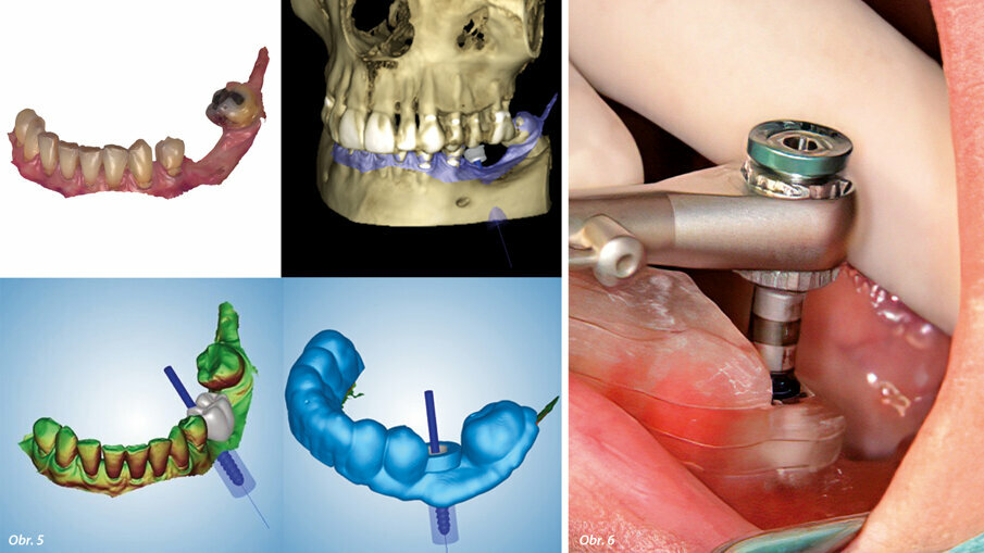 Návrh chirurgické šablony v programu Romexis, respektující požadavky na umístění implantátu i vhodné protetické řešení. Zavedení implantátu BioniQ přes chirurgickou šablonu zavaděčem implantátu s vyznačenými offsety.