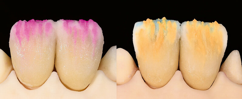 Fig. 11: Adjustment of the incisal teeth with Transpa and Mamelon materials (left: IPS d.SIGN; right: IPS Style)