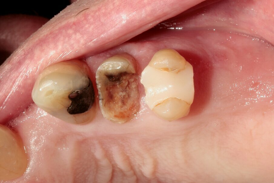 Tooth #24 was severely decayed down to the marginal bone edge.