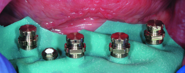 Fig. 14: Rubber dam is placed over the abutments to prevent pick-up material from locking into undercut areas below the prepared margin. SynCone caps are seated and ready to be captured into the prosthesis.