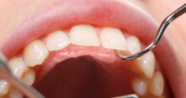 Onderzoek naar sterkere, duurzamere tandvullingen