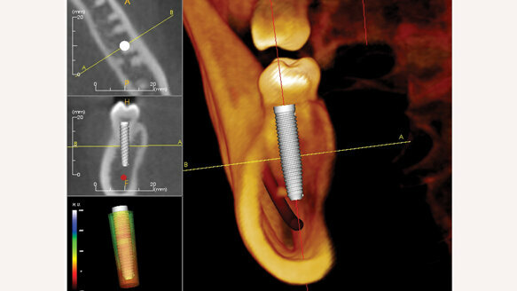 CBCT and implants: a career-altering experience