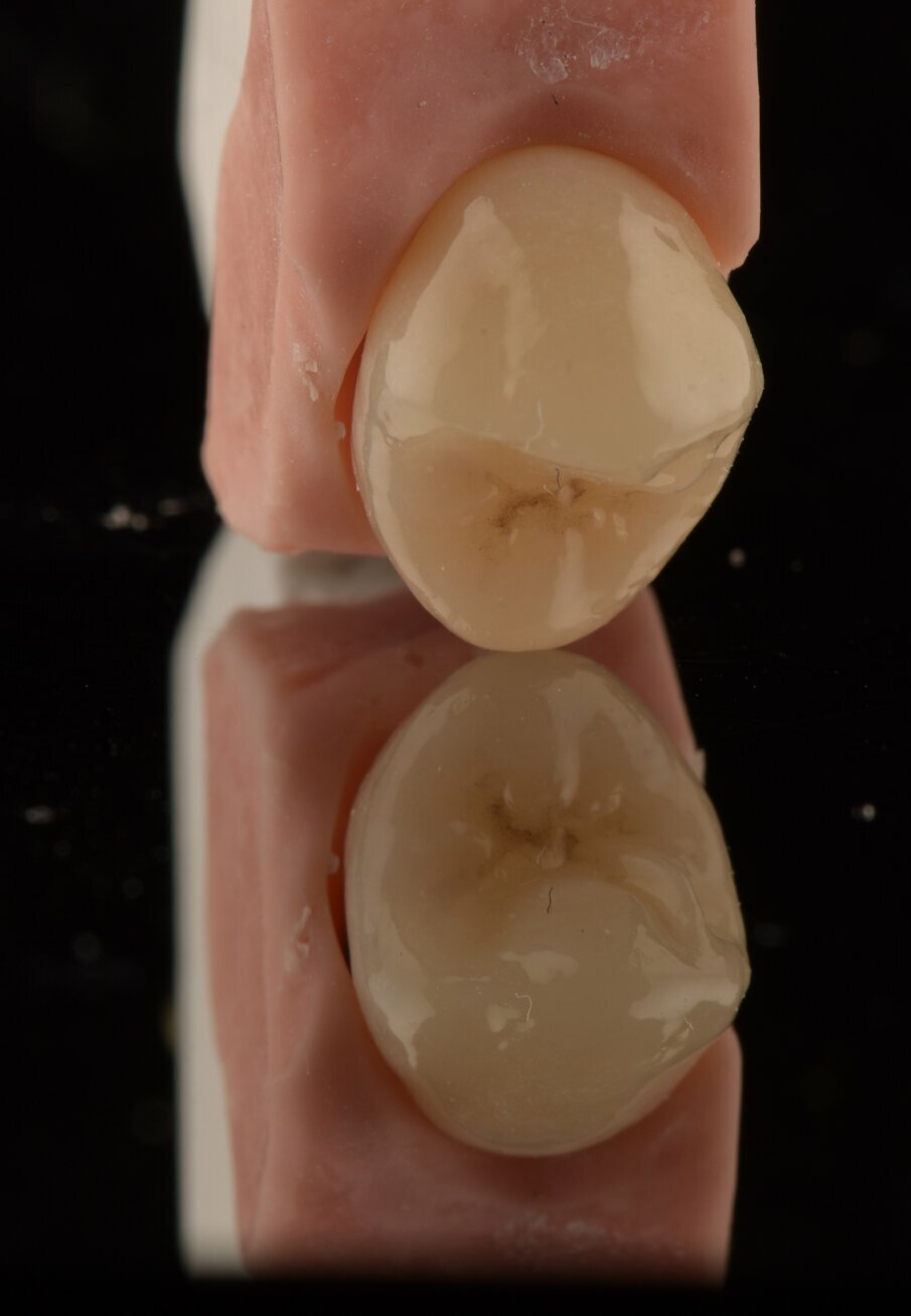 Fig. 17_Visione speculare in cui si evidenzia l’anatomia vestibolare, il cromatismo e la porzione occlusale, volutamente definita con la copia biogenetica dei denti limitrofi della giovane paziente. 