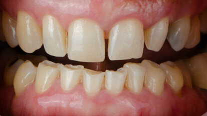 Compreender como o bruxismo afeta as restaurações dentárias