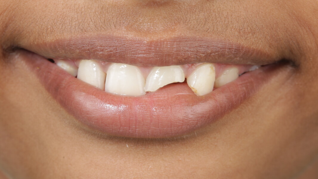 Fig 2: A close-up smile view.