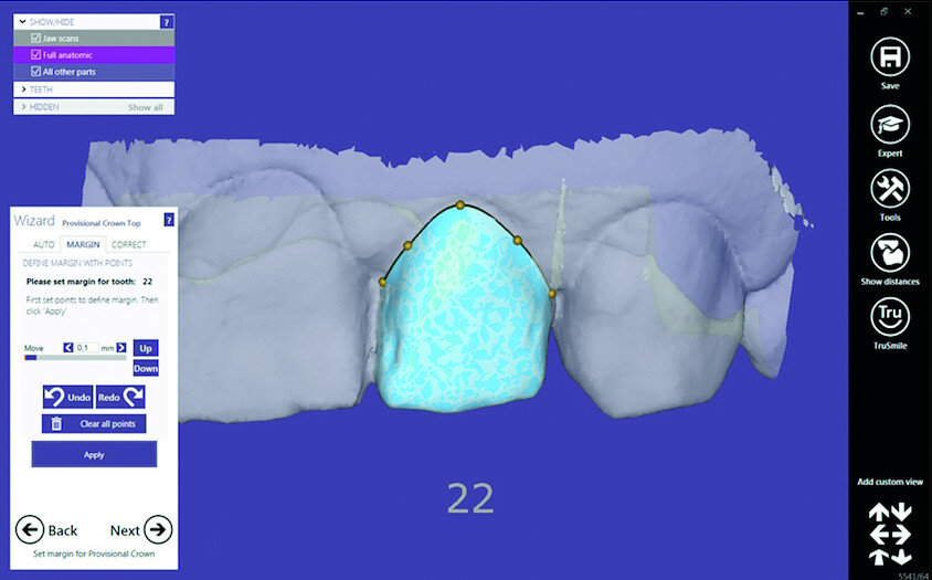 Fig. 15a: Design of the provisional prosthesis, margins set; the irregular initial state of
tooth #22 could be adjusted virtually (a). 3D PICO2 printer (b).