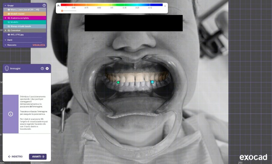 Fig. 6_Integrazione tra impronta ottica 3D e fotografie del paziente.