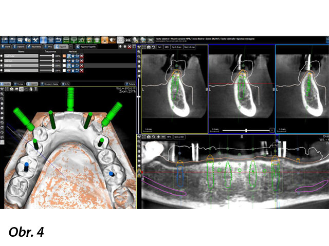 Snímek obrazovky z průběhu virtuálního plánování pozic implantátů v oblastech zubů 36, 35, 33, 42 a 46, zachycující okluzální pohled, průřez a panoramatický pohled.