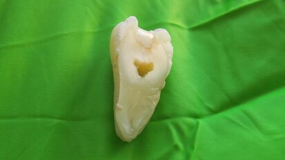 New dental reconstruction material offers improvements over acrylate-based fillers