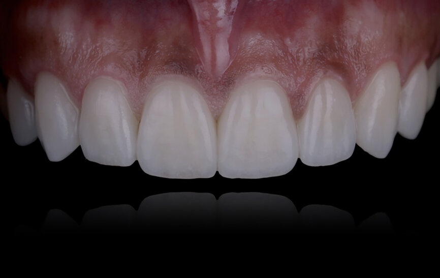 Fig. 79: Definitive restoration of the maxilla.