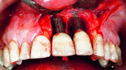 Peri-implantitis therapy - Using resorbable bone replacement material
