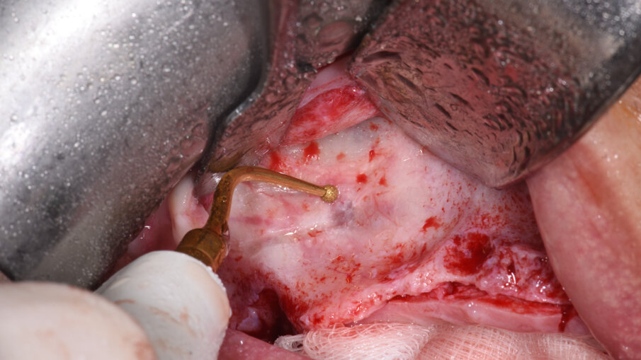 Obr. 3: Antrostomie provedená pomocí piezochirurgie.
