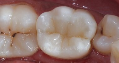 Cuspal layering technique to produce aesthetic posterior composite restorations – A case report