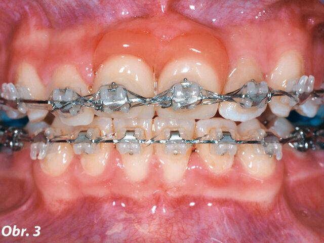 Obr. 3: Fotografie během ortodontické léčby s dočasnou náhradou centrálních řezáků  (Obr. 1–3 publikovány se svolením prof. A. Wichelhause)