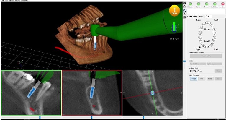 Yomi robotic system gains ground in dentistry