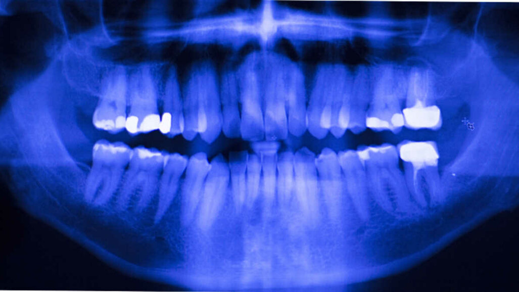 Afastando-se do amálgama: ferramenta on-line ajuda dentistas na escolha de materiais restauradores