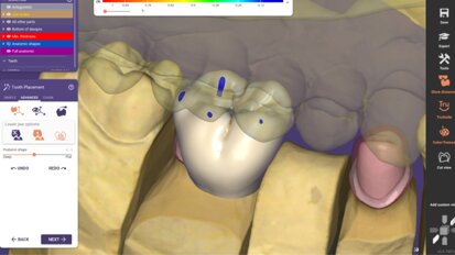DentalCAD 3.0 Galway: Exocad announces roll-out