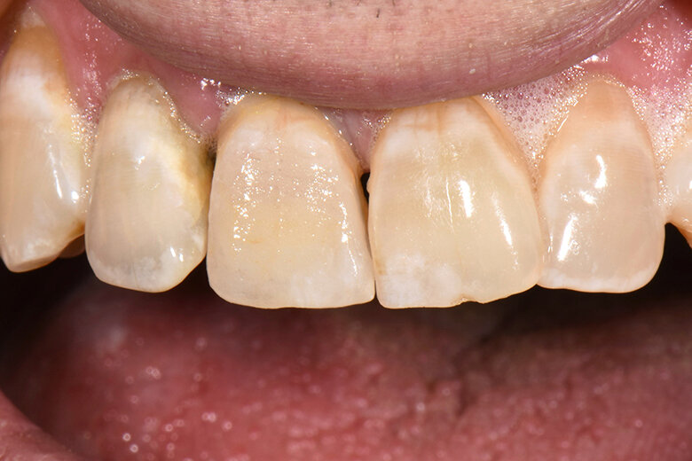 Fig. 5. La corona caracterizada y acabada durante la prueba clínica en boca.