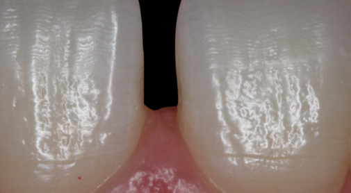 Fig. 15: Interdental papilla before direct diastema closure
