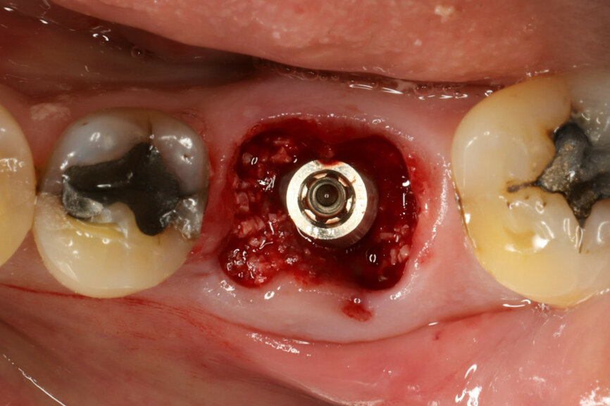 Fig. 14: Implant in final position with bone augmentation.