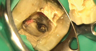 Ritrattamento di un molare inferiore